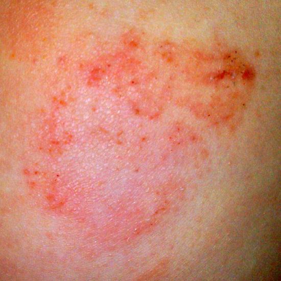 Psoriasi di seboreyny di una parte pelosa della testa