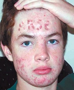 Darsonval per trattamento di risposte di acne