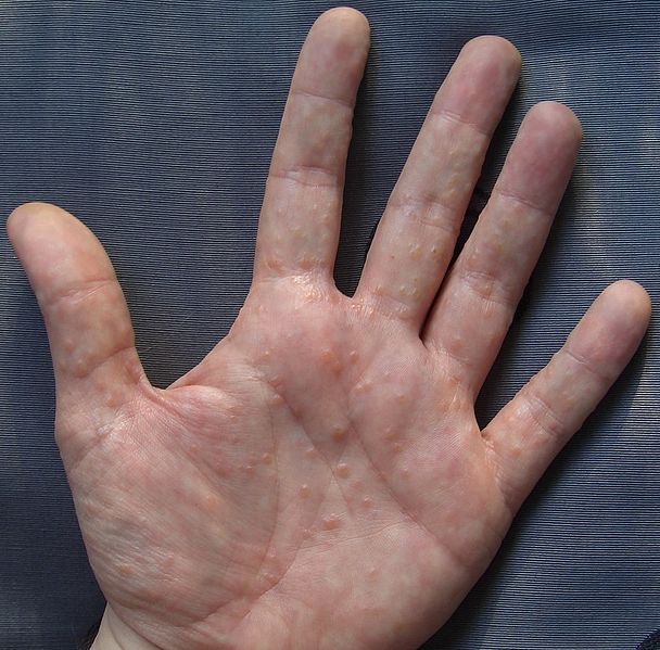 La pigmentazione su una faccia costata