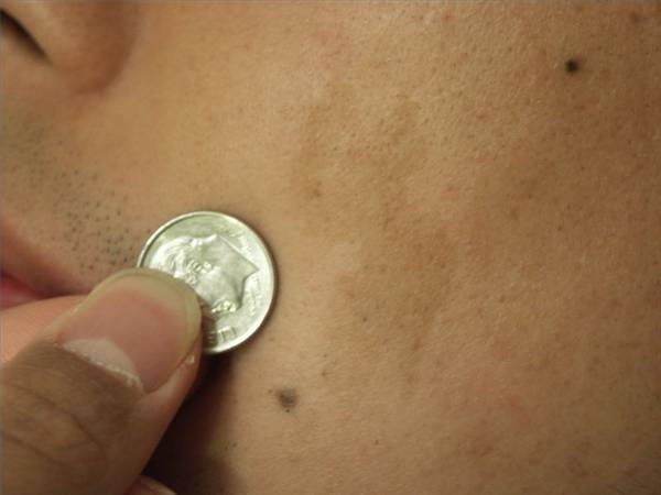 La decolorazione di pigmentary nota su una faccia sciocchezze