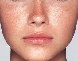 Comprare la crema contro pigmentazione