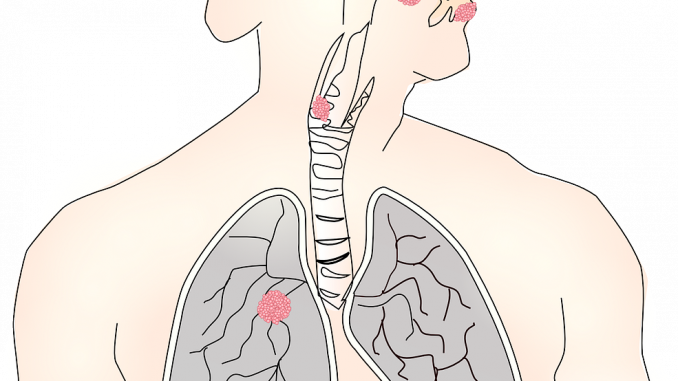 cancro alla lingua cancro alla lingua