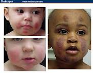 Dermatite di atopic ad adulti di medicina