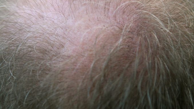 ricrescita dei capelli ricrescita dei capelli
