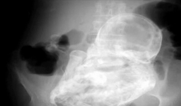 lithopedion