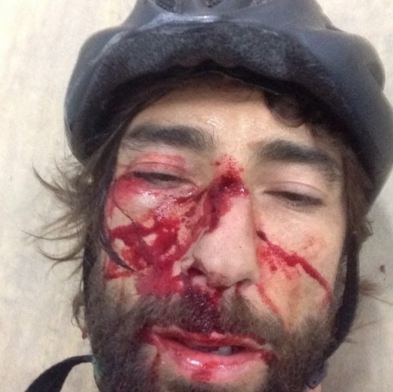 brumotti volto incidente-3