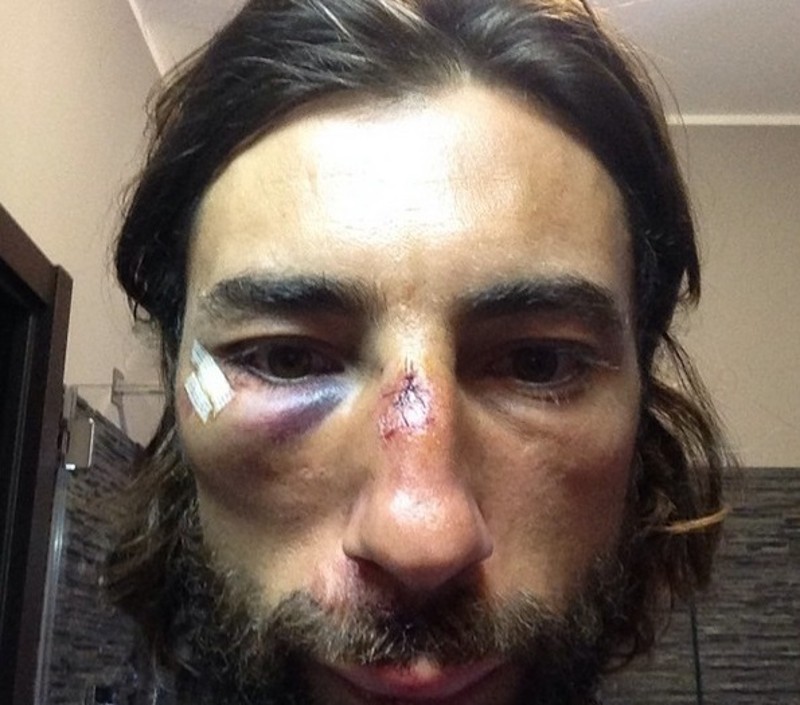 vittorio brumotti punti dopo incidente in bici