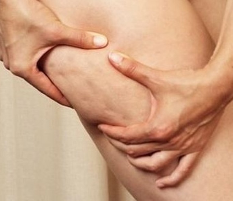 cellulite