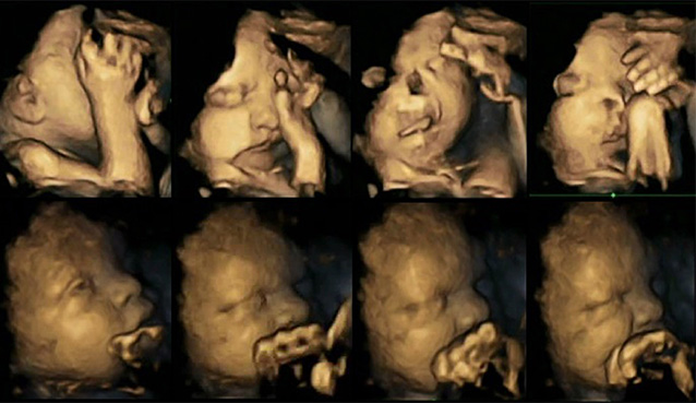 Smoking during pregnancy study