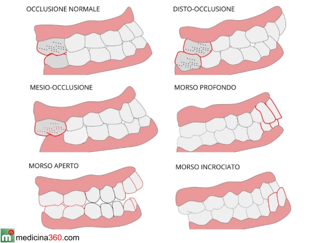 Malocclusione dentale cause Malocclusione dentale cause