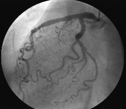 angiografiacoronarica