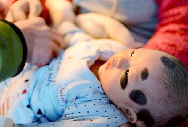 bimba con rara patologia