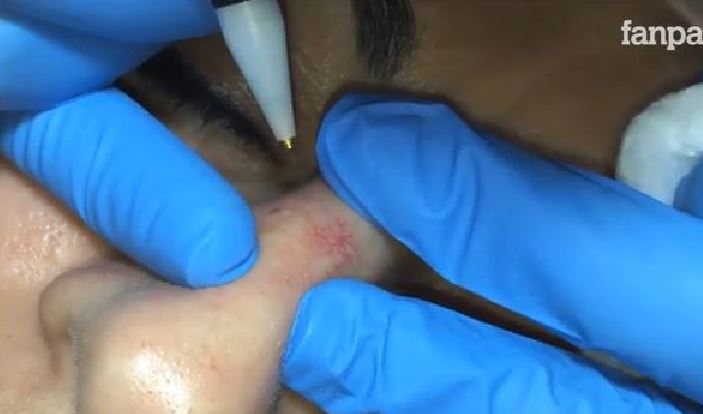 vena varicosa