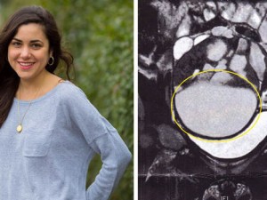 Tumour-ellie-300x225