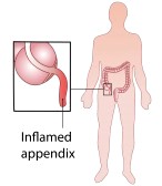 Quali sono cause alimentari appendicite