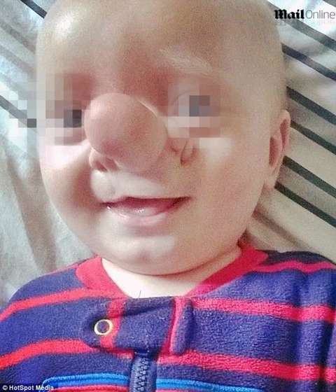 Ollie: il bambino Pinocchio, il cervello gli cresce dentro il naso