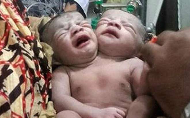 Bimbo con due teste nato in Bangladesh: la folla grida che è un miracolo