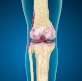 Quali sono i sintomi osteoporosi