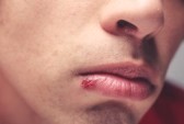 Quale è incubazione contagio Herpes Labiale