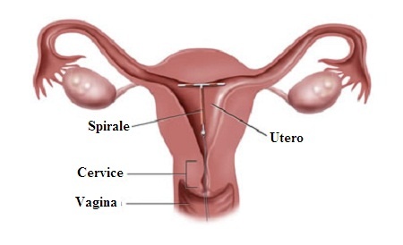 Qual è il prezzo della spirale contraccettivo