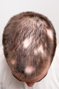 Come comportarsi con l'alopecia
