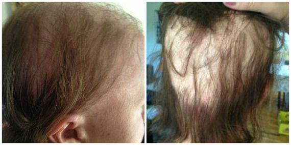 Molly, la mamma che ha perso i capelli durante la gravidanza
