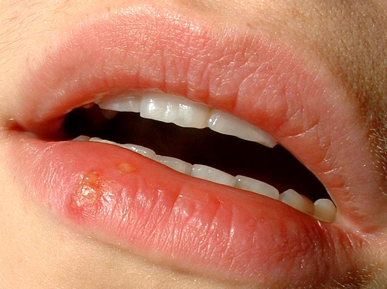 Come combattere Herpes Labiale