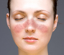 Come curare il Lupus con la dieta