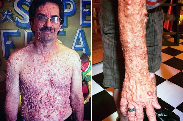 Uomo coperto di tumori si unisce ad un Freak show - diventa 'Bubble boy'