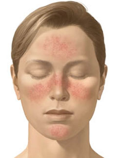 La rosacea può essere curata?