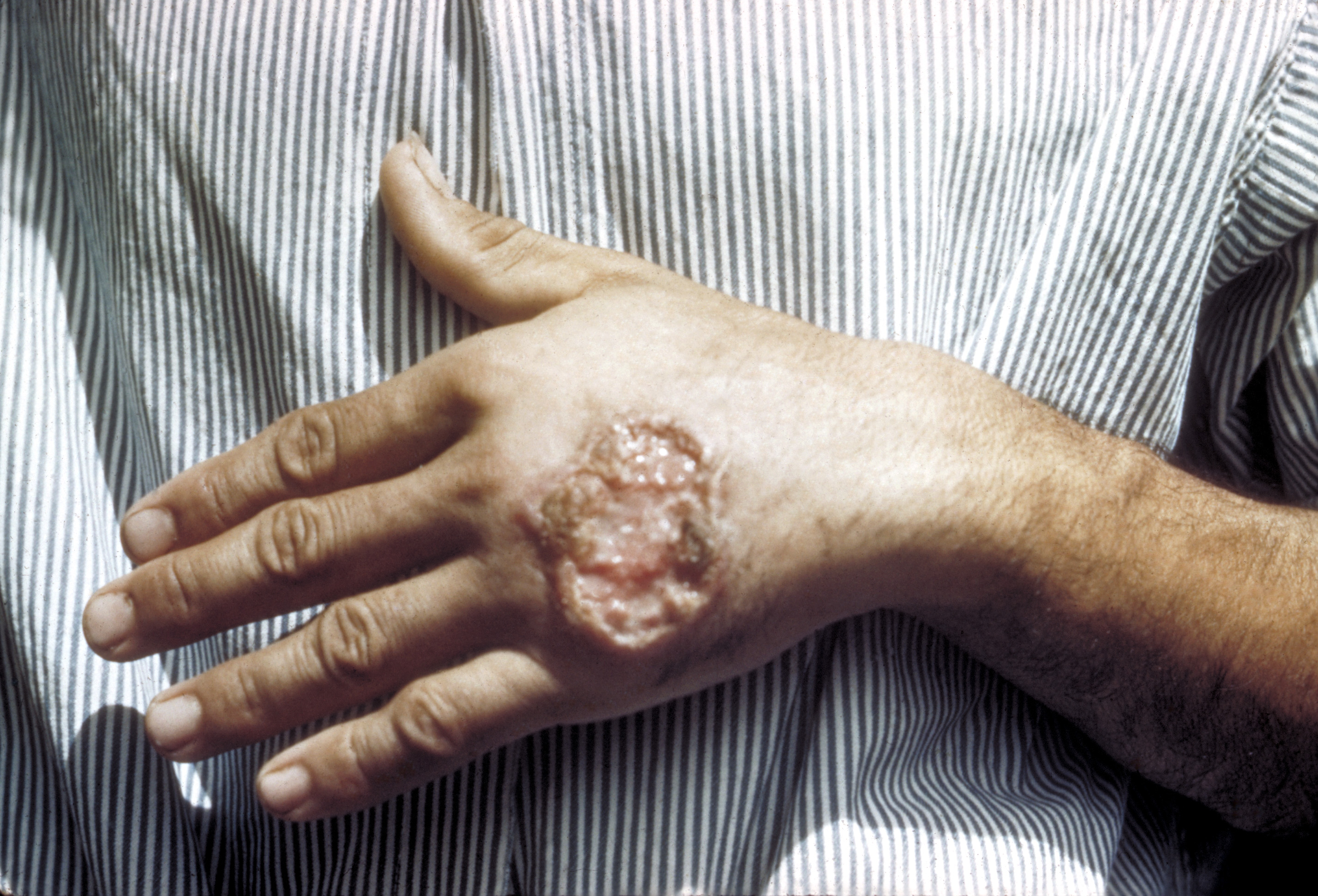 Quali sono cure per leishmaniosi