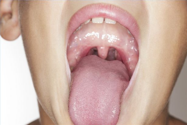 Come rimuovere le pietre tonsillari con un oggetto arrotondato