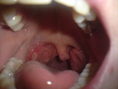 Tonsillite criptica cronica