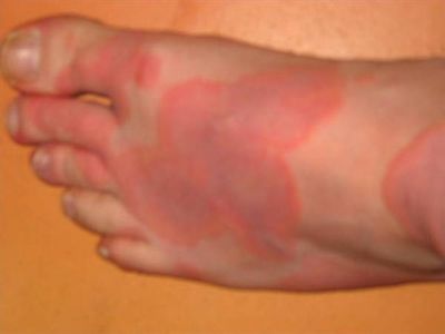 Segni e sintomi delle allergie