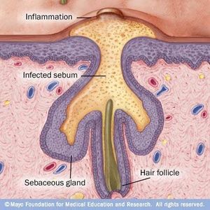Le cicatrici del'acne se ne andranno?