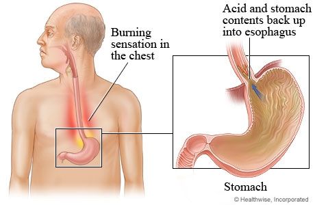 Come alleviare l'acidità di stomaco