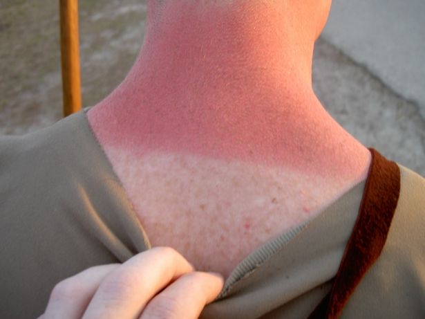 Come trattare le scottature solari con il limone