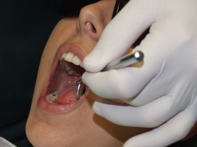 Come capire se la perdita di un dente è dovuta ad un'infezione