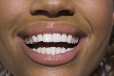rimedi veloci per denti più bianchi