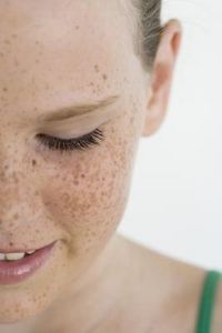 Consigli per schiarire o prevenire le lentiggini