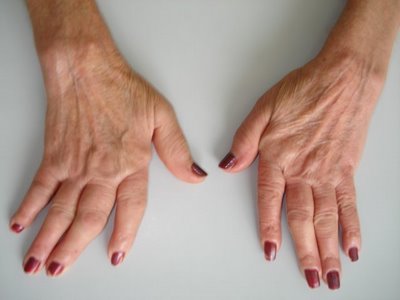 Cure per l'artrite reumatoide