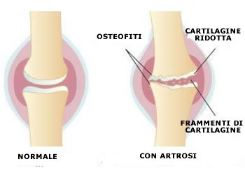 Alimenti per combattere l’artrosi