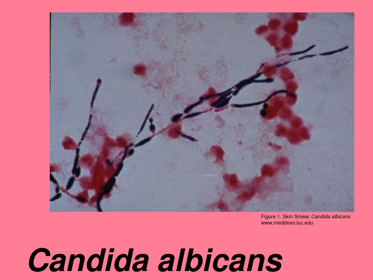 I sintomi della candida