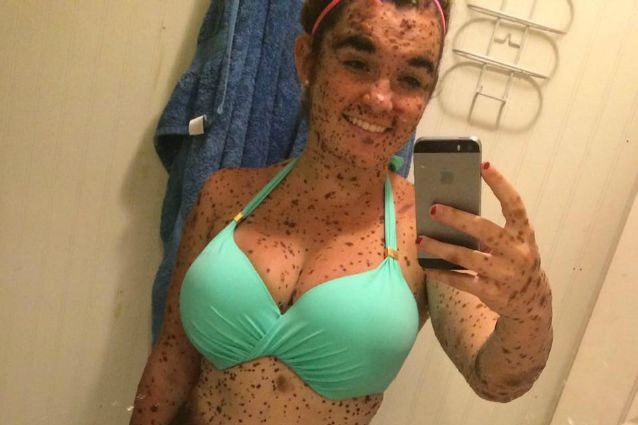Ciera, la 19enne con il 70% del corpo ricoperto da nei. "Mi chiamavano cane chiazzato"