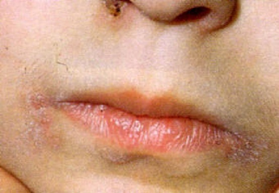 Se è possibile si libererà da eczema per sempre