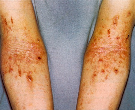 Quali sono sintomi dermatite atopica