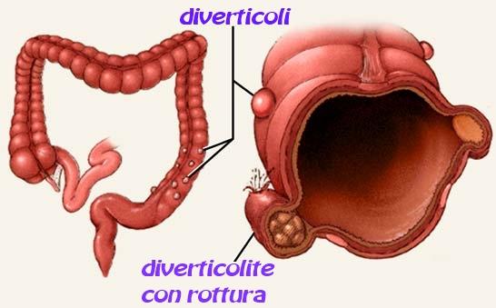 Sintomi della diverticolite