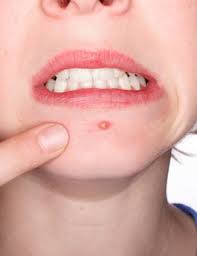 Antibiotici utilizzati per l’acne