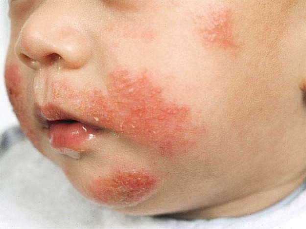 Come curare con fototerapia dermatite atopica bambini 10 anni