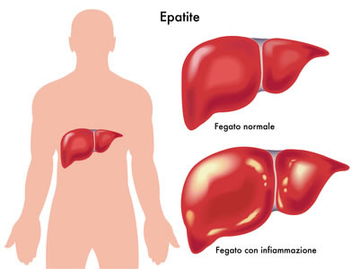 Come si guarisce dall'epatite